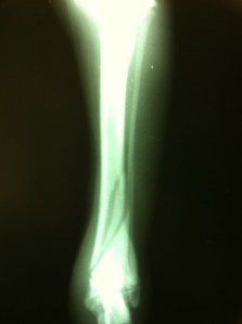  Factura de tibia dereha