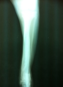 (12-03-2010) Rx caudo-craneal extremidad derecha posterior perfectamente consolidada.